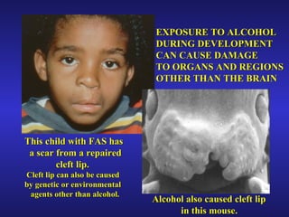 EXPOSURE TO ALCOHOL  DURING DEVELOPMENT CAN CAUSE DAMAGE  TO ORGANS AND REGIONS  OTHER THAN THE BRAIN This child with FAS has  a scar from a repaired cleft lip. Cleft lip can also be caused by genetic or environmental agents other than alcohol. Alcohol also caused cleft lip  in this mouse. 