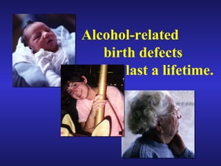 Alcohol-related birth defects last a lifetime. 