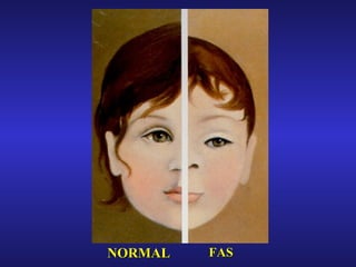 FAS NORMAL 