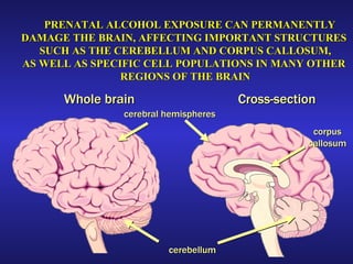 Cross-section Whole brain cerebral hemispheres cerebellum corpus callosum PRENATAL ALCOHOL EXPOSURE CAN PERMANENTLY  DAMAGE THE BRAIN, AFFECTING IMPORTANT STRUCTURES  SUCH AS THE CEREBELLUM AND CORPUS CALLOSUM, AS WELL AS SPECIFIC CELL POPULATIONS IN MANY OTHER  REGIONS OF THE BRAIN 