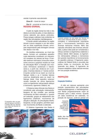areolar ricamente vascularizado
Zona IV – túnel do carpo
Zon V – proximal ao túnel do carpo
REGIÃO DORSAL
A pele da região dorsal da mão e dos
dedos é provida de pelos, é mais elástica e
menos aderente aos planos profundos.
Possui pregas cutâneas mais evidentes na
região das articulações interfalangianas.
O tecido celular subcutâneo na região
dorsal é pouco espesso e por ele transi-
tam as veias superficiais dorsais, princi-
pais responsáveis pela drenagem venosa
dos dedos e da mão.
Os tendões extensores, ao nível dos
dedos, formam um verdadeiro aparelho
cujos elementos constituem um mecanis-
mo complexo de vetores de força. O ten-
dão extensor extrínseco (músculos exten-
sores comuns e próprios) recebe ao nível
da articulação MCF a inserção dos mús-
culos intrínsecos (lumbricais e interós-
seos) e, a partir daí, divide-se em 3 por-
ções: 2 bandas laterais e 1 banda central.
A banda central irá se inserir ao nível da
falange média e as 2 bandas laterais
unem-se distalmente para se inserir na
falange distal. Este aparelho extensor
recebe inserção de vários ligamentos
como os ligamentos retinaculares oblíquo
e transverso, ligamento Cleland, etc.
O Sistema ósteo Articular dos Dedos é
constituído pela articulação metacarpofa-
langiana do tipo condilar, que permite
movimentos de flexo extensão e, quando
em extensão, graças ao relaxamento dos
ligamentos colaterais, movimentos de
adução e abdução. As articulações interfa-
langianas, do tipo gínglimo, permitem ape-
nas movimentos de flexão e extensão.
O Sistema Ligamentar dos Dedos é
complexo e extremamente importante
para o funcionamento harmônico das
diversas estruturas motoras. Além das
cápsulas articulares das diversas articula-
ções, a placa volar pode ser considerada o
reforço ventral e os ligamentos colaterais o
reforço lateral. Além desses, os ligamen-
tos retinaculares oblíquos e transversos
tem grande importância no funcionamento
do aparelho extensor. O ligamento osteo-
cutâneo de Cleland limita a excursão das
partes moles no movimento de flexo
extensão dos dedos. O ligamento de
Grayson estabiliza o feixe vásculo-nervoso
em sua posição anatômica.
INSPEÇÃO
Inspeção Estática
A mão em repouso apresenta uma
posição característica das articulações
metacarpofalangianas e interfalangianas,
com flexão progressivamente maior do
indicador para o dedo mínimo. Quando
um dedo mantém-se em extensão, na
posição de repouso, pode-se pensar em
lesão dos ten-
dões flexores.
12
À esquerda mão na posi-
ção de repouso (normal) e
à direita mão em repouso
com lesão dos flexores do
dedo médio.
Paciente portador de uma lesão dos flexores do
dedo anular realizando flexão de todos os dedos.
Sindactilia
complexa à
esquerda
(com fusão de
falanges entre
o dedos médio
e anular).
Braquisindoctilia.
 