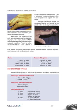 ral o hamato e o medial o pisiforme, pas-
sam o nervo e a artéria ulnar.
• Metacarpos: Os metacarpos são
mais facilmente palpáveis na região dor-
sal já que, nessa região, a pele e o TCSC
são menos espessos e os tendões exten-
sores são mais finos. Podem ser palpa-
dos com facilidade a base, a diáfise, o
colo e a cabeça dos metacarpianos. Com
a articulação metacarpo-falangiana fleti-
da a cabeça pode ser palpada mais facil-
mente.
• Falanges: As falanges podem ser
palpadas facilmente, com exceção de sua
porção volar, devido a presença de ten-
21
ATUALIZAÇÃO EM TRAUMATOLOGIA DO APARELHO LOCOMOTOR
Dedo em botoeira por lesão do tendão extensor central.
Deformidade em pescoço de cisne.
dões flexores e do túnel osteofibroso. Deve-se observar simetria, sintomas dolorosos,
edema, comparando um dedo com os outros.
DEFORMIDADES TÍPICAS
• Dedo em Martelo: Ocorre por lesão do tendão extensor terminal em sua inserção na
Punho
Flexão: 80 graus
Extensão: 80 graus
Desvio Ulnar: 30 graus
Desvio Radial: 20 graus
Metacarpofalangianas
Extensão: 30 graus
Flexão: 100 graus
Adução: 20 graus
Abdução: 30 graus
Articulação Interfalangiana Proximal
Flexão: 100-110 graus
Extensão: 0 graus
Articulação Interfalangiana distal
Flexão: 90 graus
Extensão 15 graus
Carpo-Metacarpiana
2º dedo – praticamente imóvel
3º dedo – praticamente imóvel
4º dedo – 5 graus de flexão
– 5 graus de extensão
5º dedo – 10 graus de flexão
– 10 graus de extensão
 