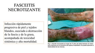 FASCEITIS
NECROTIZANTE
Infección rápidamente
progresiva de piel y tejidos
blandos, asociada a destrucción
de la fascia y de la grasa,
acompañada de toxicidad
sistémica y alta mortalidad.
 