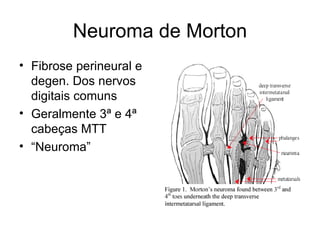 Neuroma de Morton Fibrose perineural e degen. Dos nervos digitais comuns Geralmente 3ª e 4ª cabeças MTT “ Neuroma” 