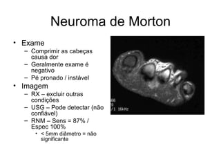 Neuroma de Morton Exame Comprimir as cabeças causa dor Geralmente exame é negativo Pé pronado / instável Imagem RX – excluir outras condições USG – Pode detectar (não confiável) RNM – Sens = 87% / Espec 100% < 5mm diâmetro = não significante 