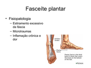 Fasceíte plantar Fisiopatologia Estiramento excessivo da fáscia Microtraumas Inflamação crônica e dor 