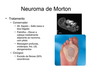 Neuroma de Morton Tratamento Conservador Alt. Sapato – Salto baixo e bico folgado Palmilha – Elevar a cabeça medialmente adjacente ao neuroma, com piloto Massagem profunda, crioterapia, frio, US, alongamentos Cirúrgico Excisão da fibrose (50% recorrência) 