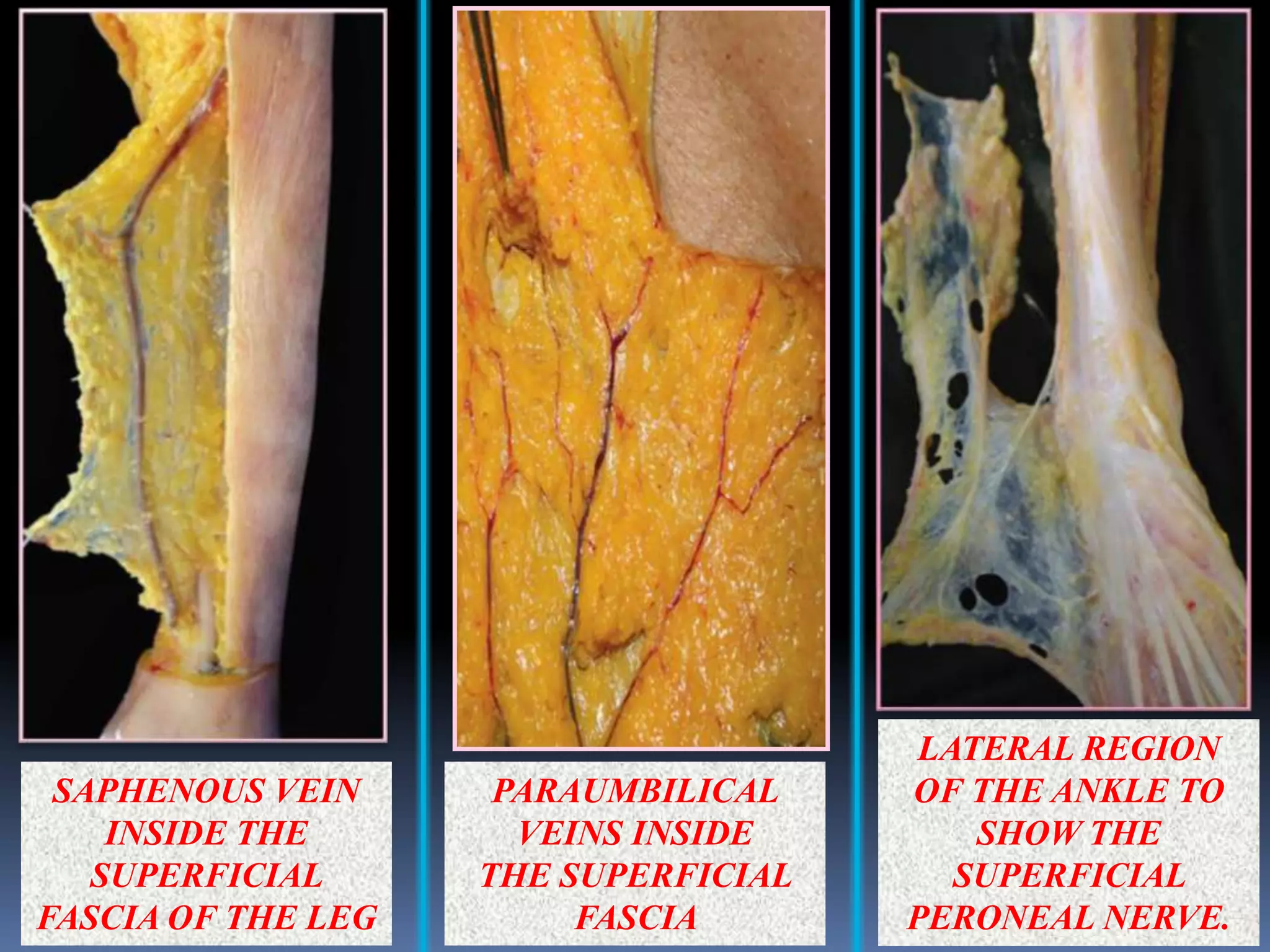 SAPHENOUS VEIN
INSIDE THE
SUPERFICIAL
FASCIA OF THE LEG
PARAUMBILICAL
VEINS INSIDE
THE SUPERFICIAL
FASCIA
LATERAL REGION
OF THE ANKLE TO
SHOW THE
SUPERFICIAL
PERONEAL NERVE.
 