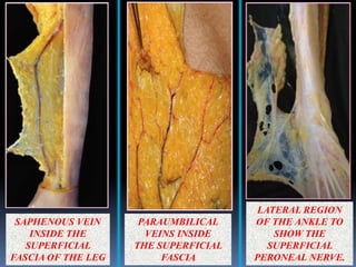 SAPHENOUS VEIN
INSIDE THE
SUPERFICIAL
FASCIA OF THE LEG
PARAUMBILICAL
VEINS INSIDE
THE SUPERFICIAL
FASCIA
LATERAL REGION
OF THE ANKLE TO
SHOW THE
SUPERFICIAL
PERONEAL NERVE.
 