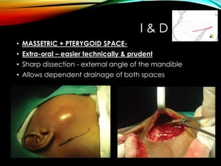 I & D 
• MASSETRIC + PTERYGOID SPACE- 
• Extra-oral – easier technically & prudent 
• Sharp dissection - external angle of the mandible 
• Allows dependent drainage of both spaces 
 