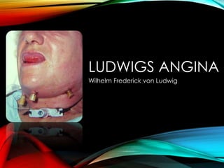 LUDWIGS ANGINA 
Wilhelm Frederick von Ludwig 
 