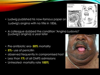 • Ludwig published his now-famous paper on 
Ludwig's angina with no title in 1836. 
• A colleague dubbed the condition "Angina Ludovici" 
(Ludwig's angina) a year later 
• Pre-antibiotic era- 50% mortality 
• 5%- use of penicillin 
• observed frequently in compromised host 
• Less than 1% of all OMFS admissions 
• Untreated- mortality rate 100% 
 