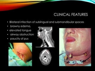 CLINICAL FEATURES 
• Bilateral infection of sublingual and submandibular spaces 
• brawny edema, 
• elevated tongue 
• airway obstruction 
• paucity of pus 
 