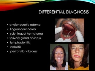 DIFFERENTIAL DIAGNOSIS 
• angioneurotic edema 
• lingual carcinoma 
• sub- lingual hematoma 
• salivary gland abscess 
• lymphadenitis 
• cellulitis 
• peritonsilar abscess 
 