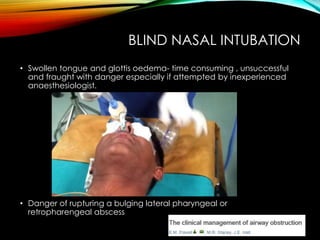 BLIND NASAL INTUBATION 
• Swollen tongue and glottis oedema- time consuming , unsuccessful 
and fraught with danger especially if attempted by inexperienced 
anaesthesiologist. 
• Danger of rupturing a bulging lateral pharyngeal or 
retropharengeal abscess 
 