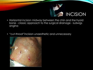 INCISION 
• Horizontal incision midway between the chin and the hyoid 
bone - classic approach to the surgical drainage - ludwigs 
angina 
• “cut-throat”incision unaesthetic and unnecessary 
 