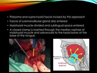 • Platysma and supra-hyoid fascia incised by this approach 
• Fascia of submandibular gland also entered 
• Mylohyoid muscle divided and sublingual space entered 
• A closed clamp is inserted through the median raphae of 
mylohyoid muscle and advanced to the hyoid bone at the 
base of the tongue 
 