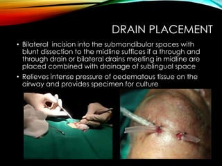 DRAIN PLACEMENT 
• Bilateral incision into the submandibular spaces with 
blunt dissection to the midline suffices if a through and 
through drain or bilateral drains meeting in midline are 
placed combined with drainage of sublingual space 
• Relieves intense pressure of oedematous tissue on the 
airway and provides specimen for culture 
 