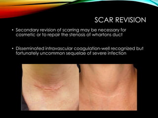 SCAR REVISION 
• Secondary revision of scarring may be necessary for 
cosmetic or to repair the stenosis of whartons duct 
• Disseminated intravascular coagulation-well recognized but 
fortunately uncommon sequelae of severe infection 
 