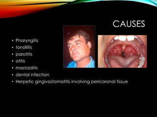 CAUSES 
• Pharyngitis 
• tonsillitis 
• parotitis 
• otitis 
• mastoiditis 
• dental infection 
• Herpetic gingivostomatitis involving pericoronal tissue 
 