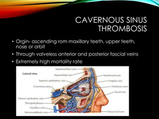 CAVERNOUS SINUS 
THROMBOSIS 
• Orgin- ascending rom maxillary teeth, upper teeth, 
nose or orbit 
• Through valveless anterior and posterior fascial veins 
• Extremely high mortality rate 
 