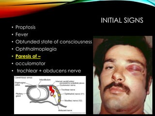 INITIAL SIGNS 
• Proptosis 
• Fever 
• Obtunded state of consciousness 
• Ophthalmoplegia 
• Paresis of – 
• occulomotor 
• trochlear + abducens nerve 
 