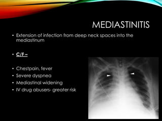 MEDIASTINITIS 
• Extension of infection from deep neck spaces into the 
mediastinum 
• C/F – 
• Chestpain, fever 
• Severe dyspnea 
• Mediastinal widening 
• IV drug abusers- greater risk 
 