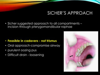 SICHER’S APPROACH 
• Sicher suggested approach to all compartments – 
incision through pterygomandibular raphae 
• Feasible in cadavers - not trismus 
• Oral approach-compromise airway 
• purulent oozing pus 
• Difficult drain - loosening 
 