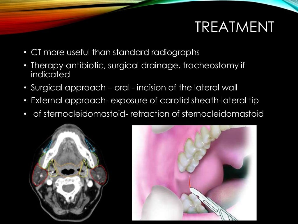 Fascial Space Infection part 2