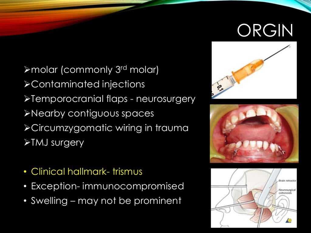Fascial Space Infection part 2
