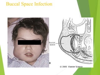 Buccal Space Infection
 