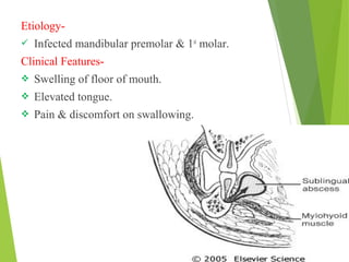 Etiology-
 Infected mandibular premolar & 1st
molar.
Clinical Features-
 Swelling of floor of mouth.
 Elevated tongue.
 Pain & discomfort on swallowing.
 