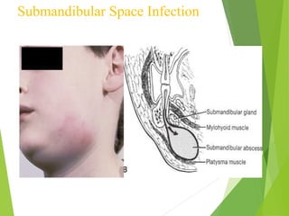 Submandibular Space Infection
 
