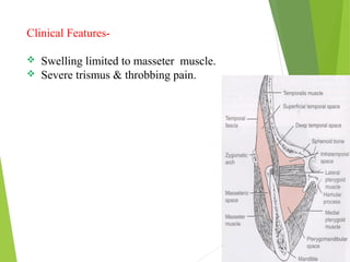 Clinical Features-
 Swelling limited to masseter muscle.
 Severe trismus & throbbing pain.
 