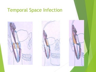 Temporal Space Infection
 