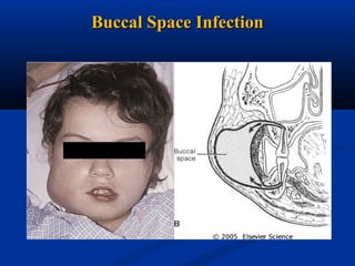 Buccal Space Infection

 