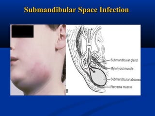 Submandibular Space Infection

 