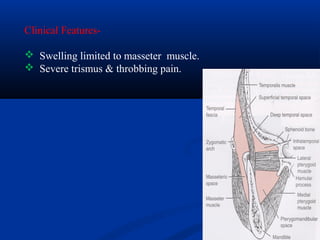 Clinical Features Swelling limited to masseter muscle.
 Severe trismus & throbbing pain.

 