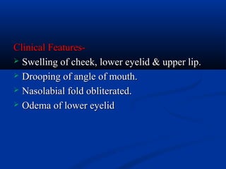 Clinical Features Swelling of cheek, lower eyelid & upper lip.
 Drooping of angle of mouth.
 Nasolabial fold obliterated.
 Odema of lower eyelid

 