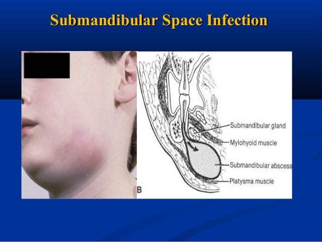 Fascial space & infections uvula diagram 