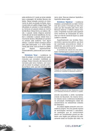 polia arciforme (A 1) pode se tornar estreita
para a passagem de tendões flexores dos
dedos. Nessa situação ocorrerá um trave-
mento do dedo na posição de flexão, deno-
minado dedo em gatilho (trigger finger). Pela
dificuldade em penetrar no túnel osteofibro-
so, forma-se um pseudo nódulo ao nível do
tendão flexor. Dessa forma, ao realizar a fle-
xão, o pseudo nódulo dirige-se proximal-
mente até sair do túnel osteofibroso. Ao rea-
lizar a extensão o pseudo nódulo trava o
movimento devido a dificuldade em penetrar
na primeira polia arciforme. Com algum
esforço, o pseudo nódulo consegue passar
pela polia estenosada, e aí, correr rapida-
mente pelo túnel, como se fosse um gatilho
que dispara repentinamente.
Ocasionalmente, pode-se até ouvir um esta-
lido.
Eminência Tenar – Localiza-se na
base do polegar, e é constituída por quatro
músculos que concedem mobilidade ao
polegar. Esses músculos são basicamente
inervados pelo nervo mediano, com exce-
ção do adutor do polegar e porção profun-
da do flexor curto, que são inervados pelo
nervo ulnar. Deve-se observar hipotrofia e
hipertrofia dessa região.
Eminência Hipotenar – Localiza-se
imediata e proximalmente ao dedo mínimo
indo até o punho. É formada por três mús-
culos que são inervados pelo nervo ulnar.
Deve-se observar o trofismo desses mús-
culos. A hipotrofia muscular pode aparecer
como síndrome de compressão do nervo
ulnar ao nível do Canal de Guyon ou canal
cubital no cotovelo.
Superficialmente aos tendões flexo-
res existe a aponeurose palmar, que deve
ser examinada procurando-se nódulo e
aderências, que podem ser as caracterís-
ticas da Moléstia de Dupuytren.
O aumento de volume de uma articu-
lação interfalangiana poderá traduzir uma
sinovite secundária a artrite reumatóide
(nódulo de Bouchart). Da mesma forma,
os nódulos duros e dolorosos localizados
na articulação interfalangiana distal são
característicos da osteoartrose (nódulos
de Heberden).
As polpas digitais possuem uma con-
sistência própria. Há uma grande riqueza
de terminações nervosas e vasculares.
As patologias que as comprometem
devem ser consideradas graves por afe-
tarem uma região que participa de prati-
camente todas as funções das mãos. As
18
Palpação do processo estilóide do rádio. Distalmente
encontra-se o escafóide na tabaqueira anatômica.
Palpação do tubérculo de Lister. Distalmente e no eixo
do 3º metacarpo encontra-se o semilunar e o capitato.
 