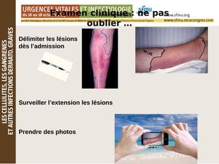 Examen clinique : ne pas
oublier …
Délimiter les lésions
dès l’admission
Surveiller l’extension les lésions
Prendre des photos
 