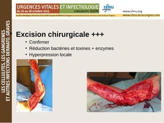 • Excision chirurgicale +++
●
Confirmer
●
Réduction bactéries et toxines + enzymes
●
Hyperpression locale
 
