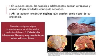 o En algunos casos, las fasciolas adolescentes quedan atrapadas y
al morir dejan cavidades con tejido necrótico.
o Ahí se pueden encontrar espinas que quedan como signo de su
presencia.
Cuando consiguen migrar
correctamente, se sitúan en los
conductos biliares  Estasis biliar,
inflamación, fibrosis y engrosamiento de
estos, asi como litiasis.
 
