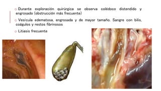 o Durante exploración quirúrgica se observa colédoco distendido y
engrosado (obstrucción más frecuente)
o Vesícula edematosa, engrosada y de mayor tamaño. Sangre con bilis,
coágulos y restos fibrinosos
o Litiasis frecuente
 