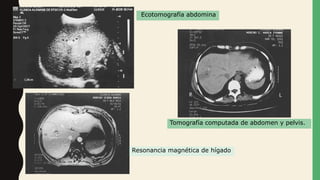 Resonancia magnética de hígado
Tomografía computada de abdomen y pelvis.
Ecotomografía abdomina
 