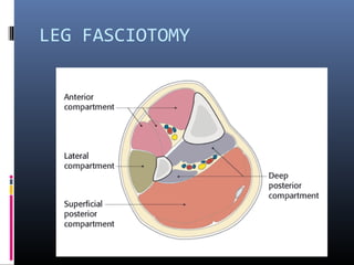 LEG FASCIOTOMY
 