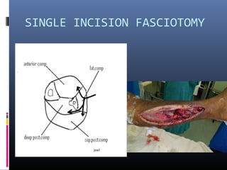 SINGLE INCISION FASCIOTOMY
 
