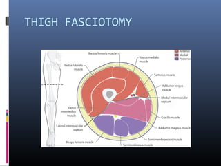 THIGH FASCIOTOMY
 