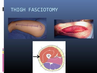 THIGH FASCIOTOMY
 